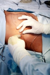 liposukcija